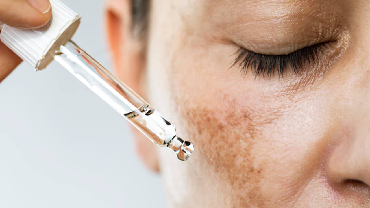 Hyperpigmentation Hyperpigmentation