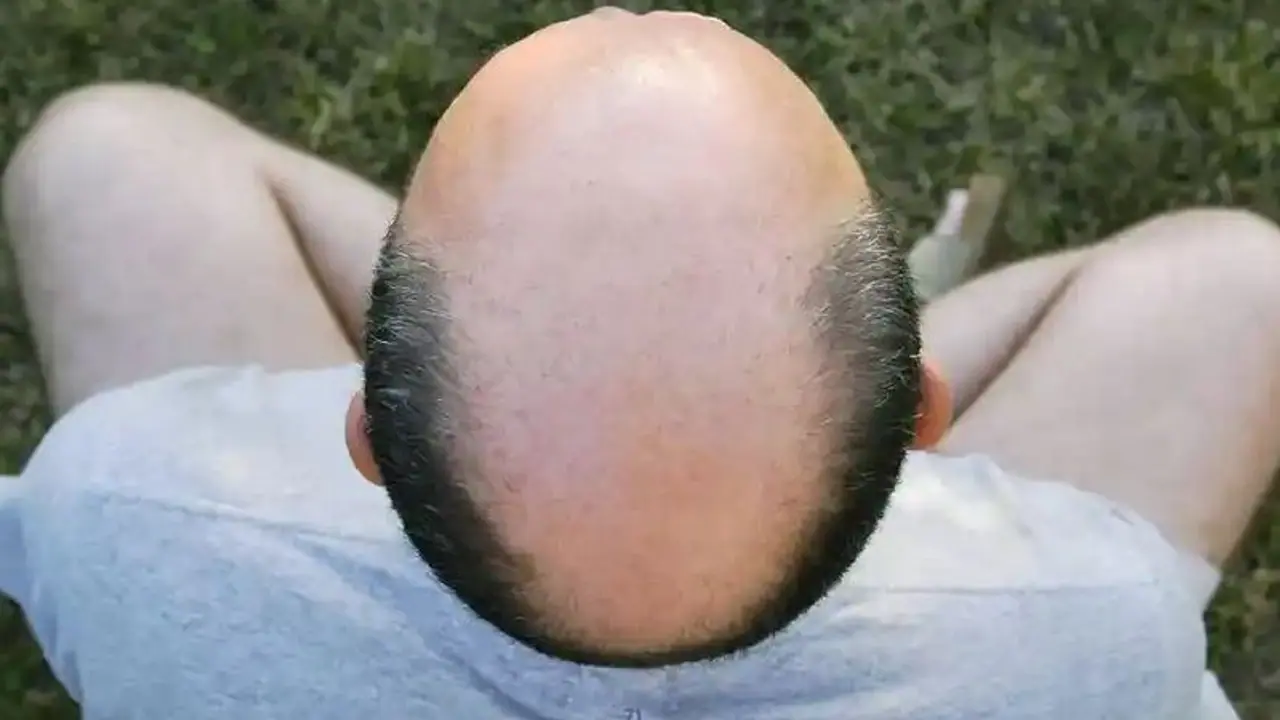 bald bald