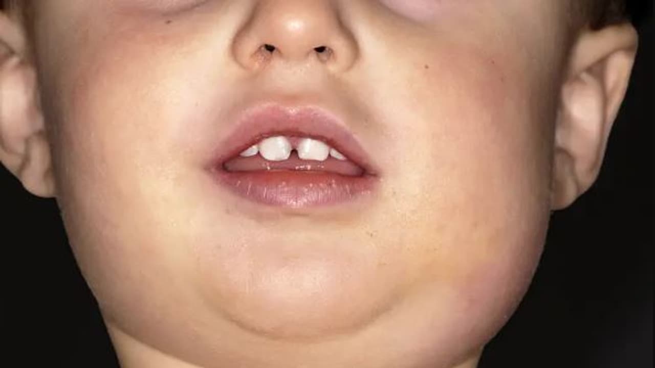 Mumps Mumps
