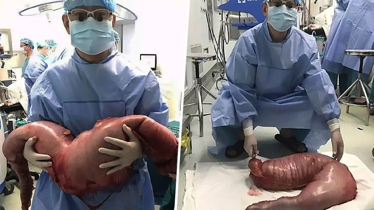 In California 30 pounds of stool accumulated in the stomach must be removed bsm