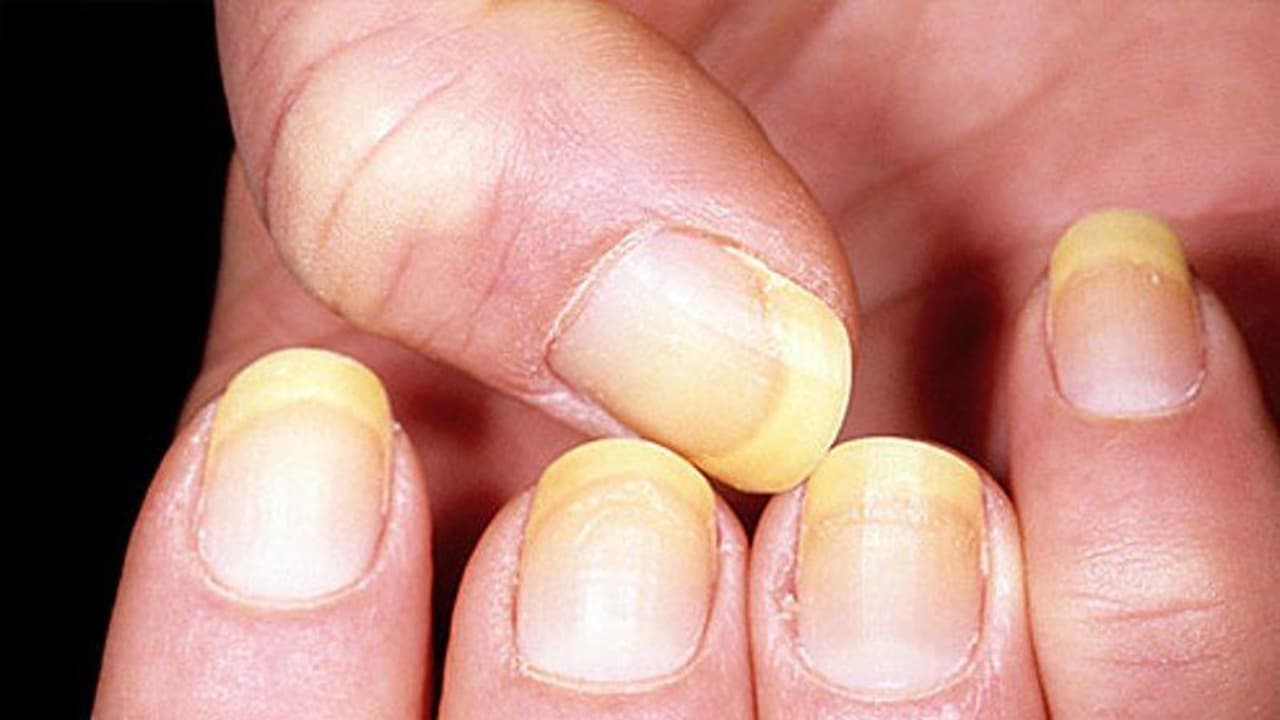 yellow nails yellow nails