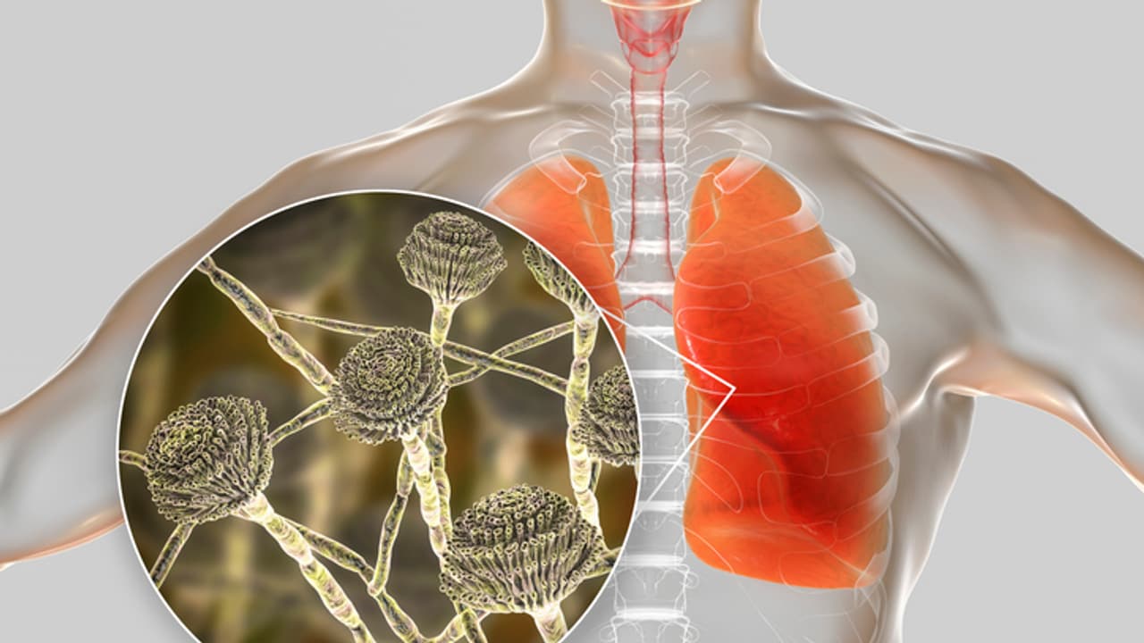 Aspergillus Fumigatus Aspergillus Fumigatus