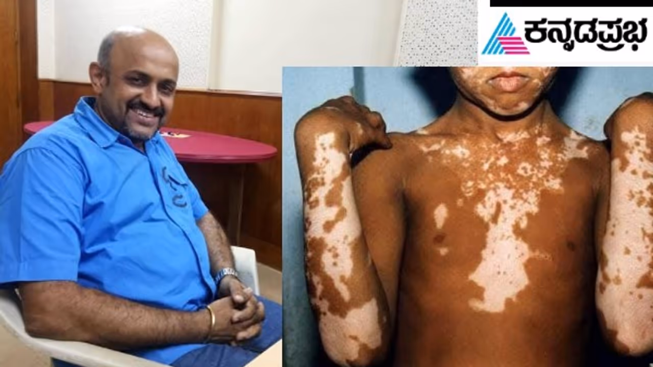vitiligo vitiligo