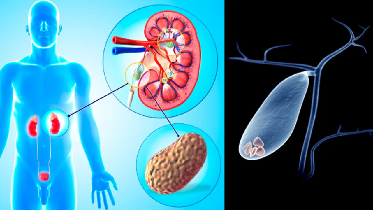 Kidney Vs Gallbladder Stone Kidney Vs Gallbladder Stone