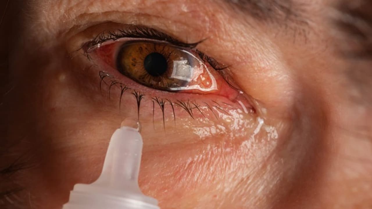 Conjunctivitis Conjunctivitis