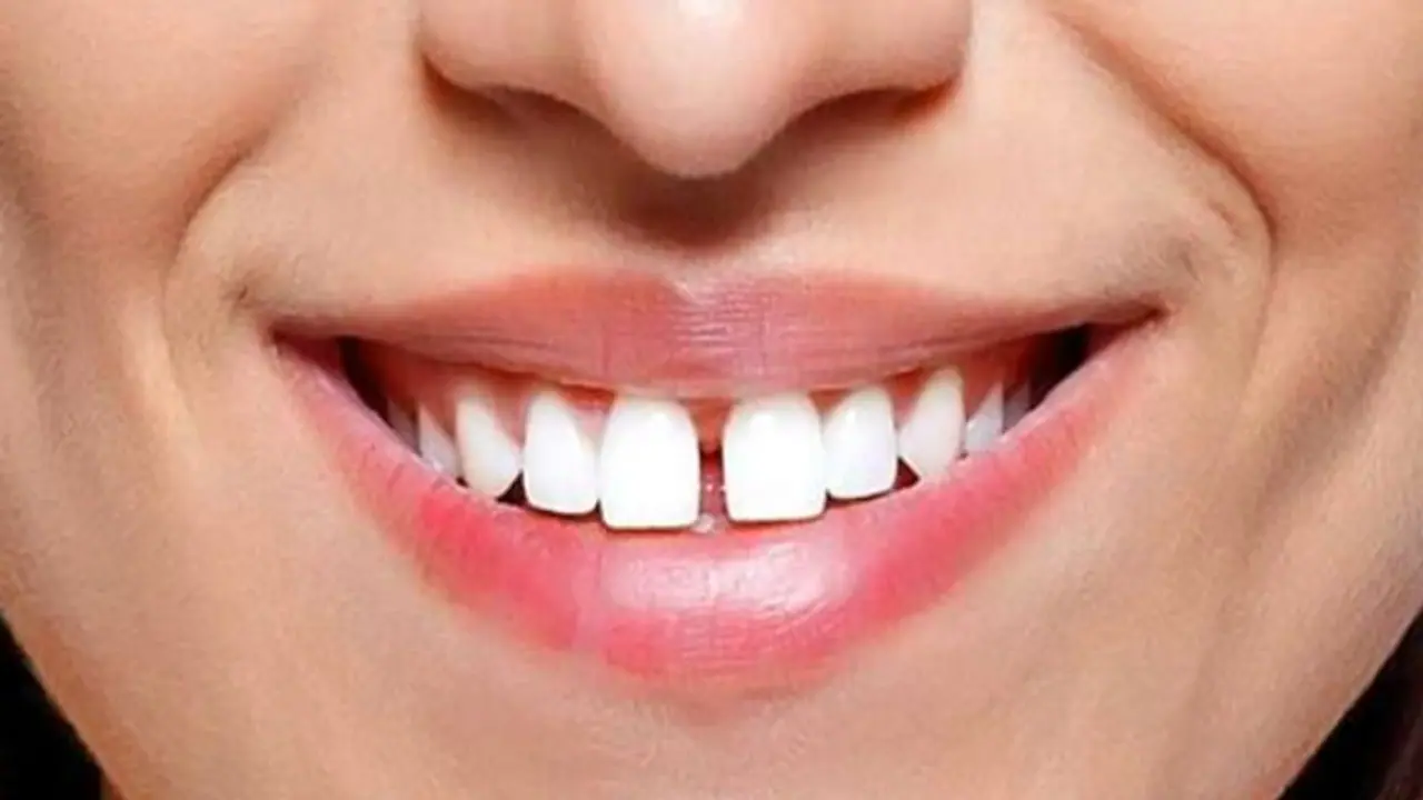 Meaning of gap teeth Meaning of gap teeth