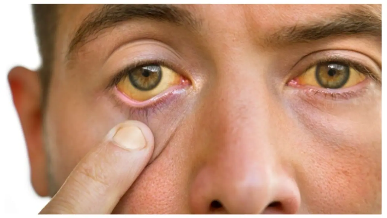 jaundice