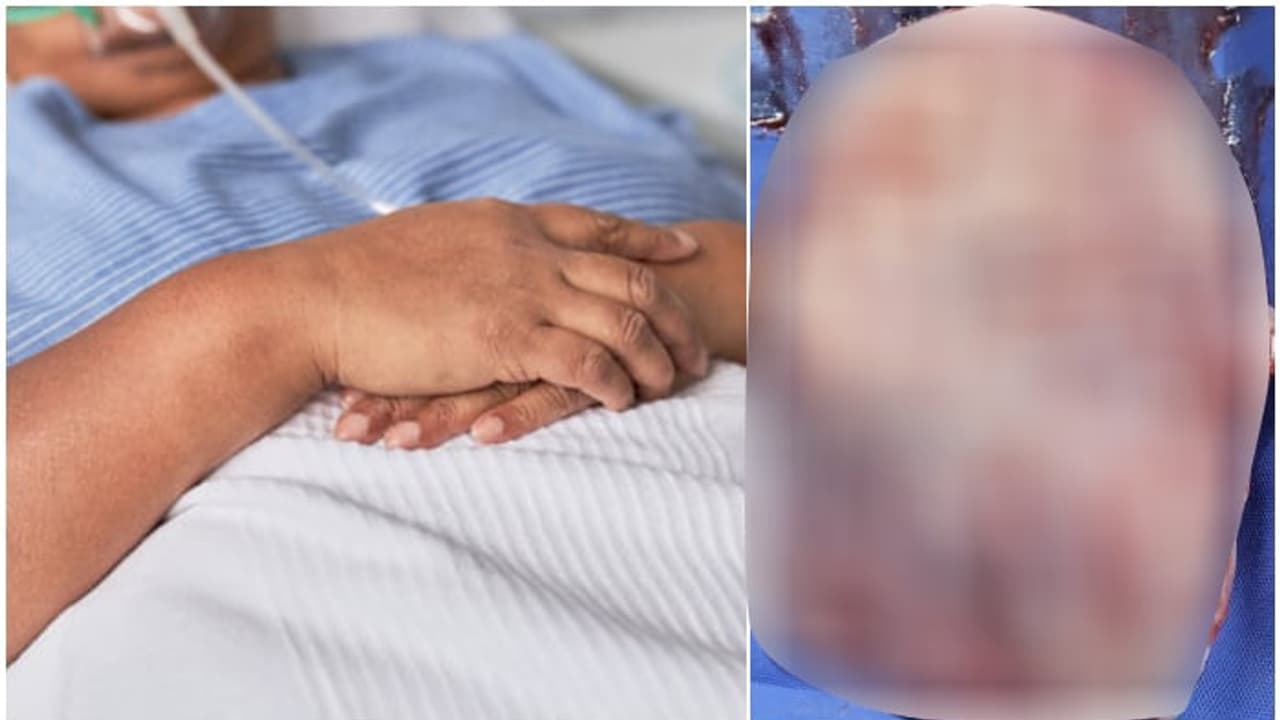 7 kilogram ovarian tumor 7 kilogram ovarian tumor