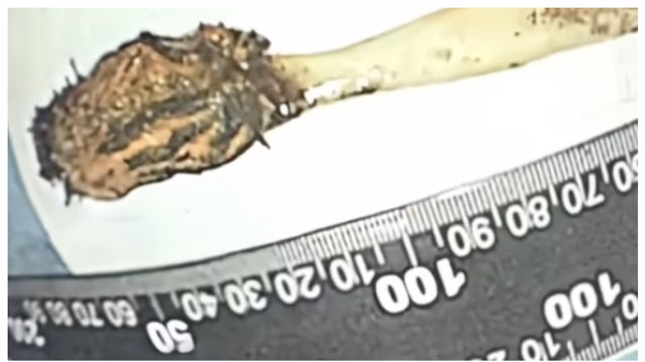 toothbrush swallowed at age of 12 was remove at age of 64 in surgery