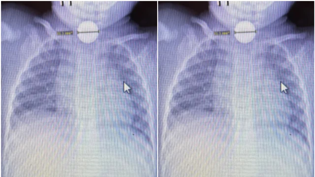 Toddler swallowed button battery 