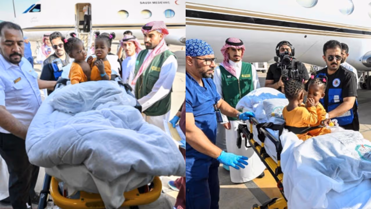 jamaican conjoined twins reached riyadh jamaican conjoined twins reached riyadh