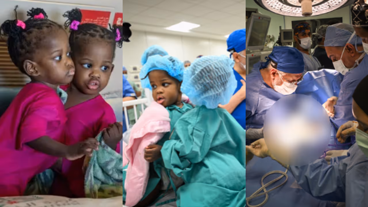 coinjoined twins coinjoined twins