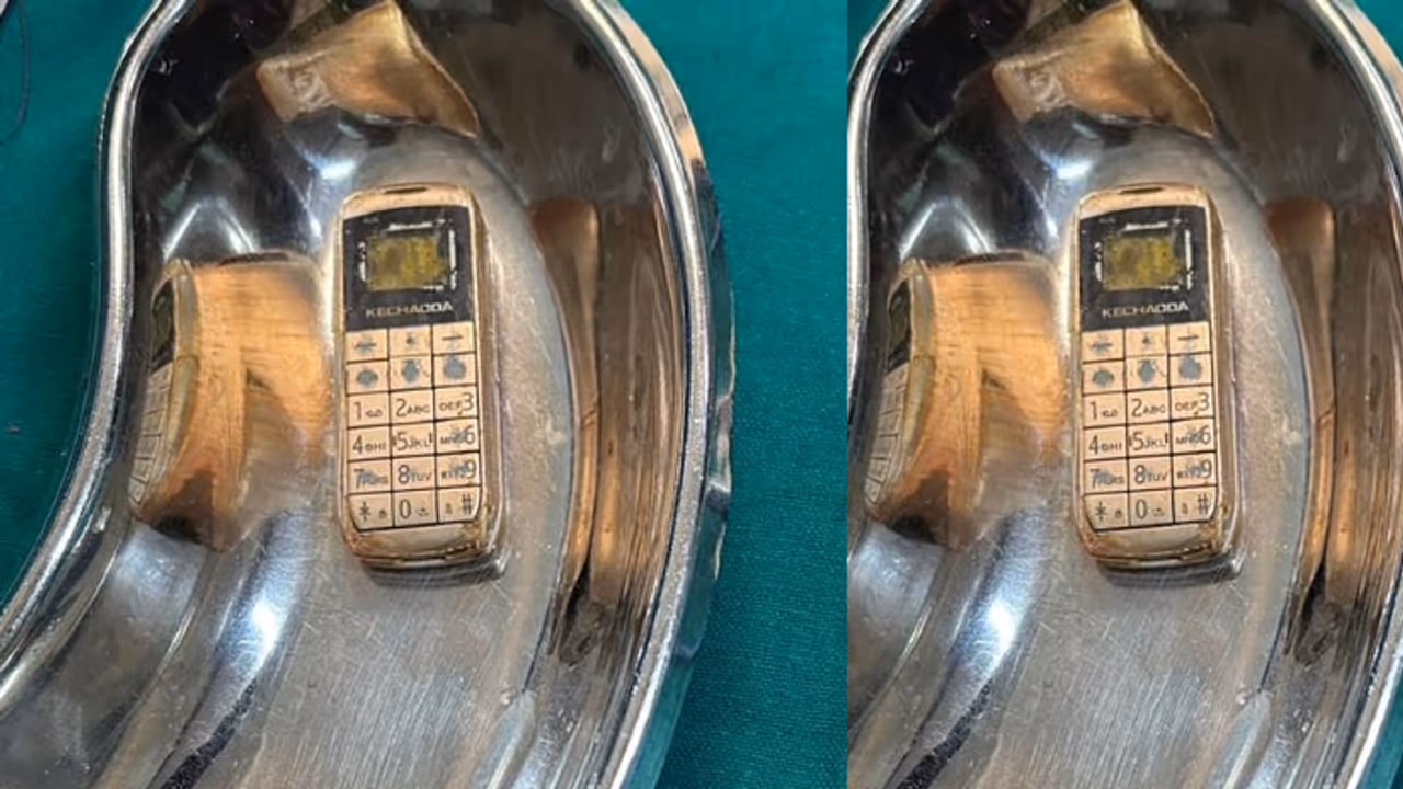 mobile phone removed from the stomach