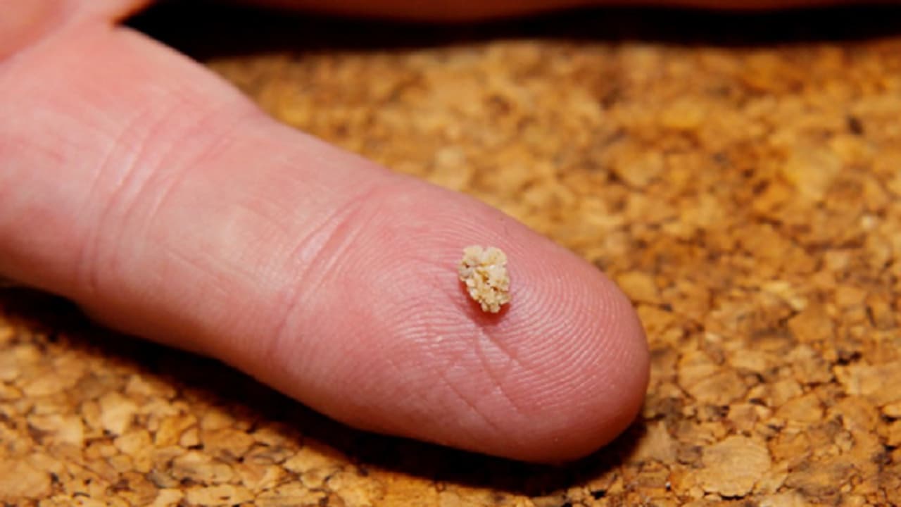 kidney stone