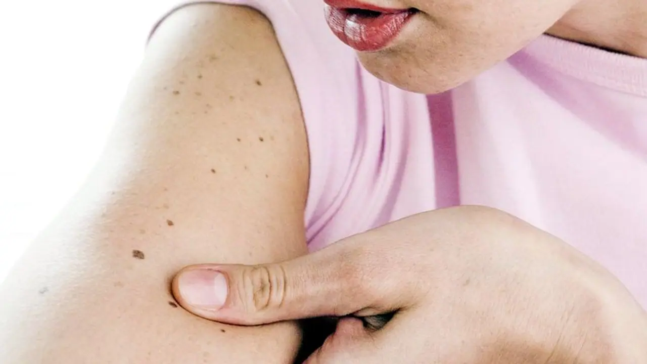 skin cancer skin cancer