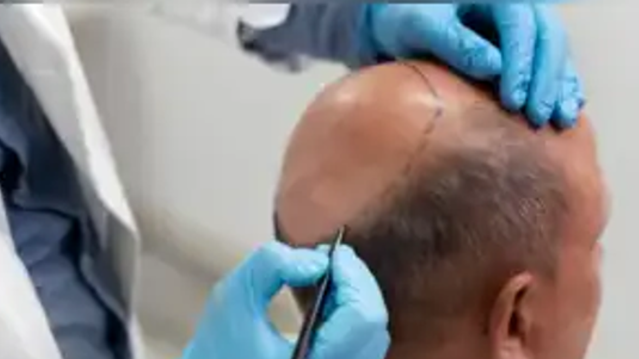 hair transplant hair transplant
