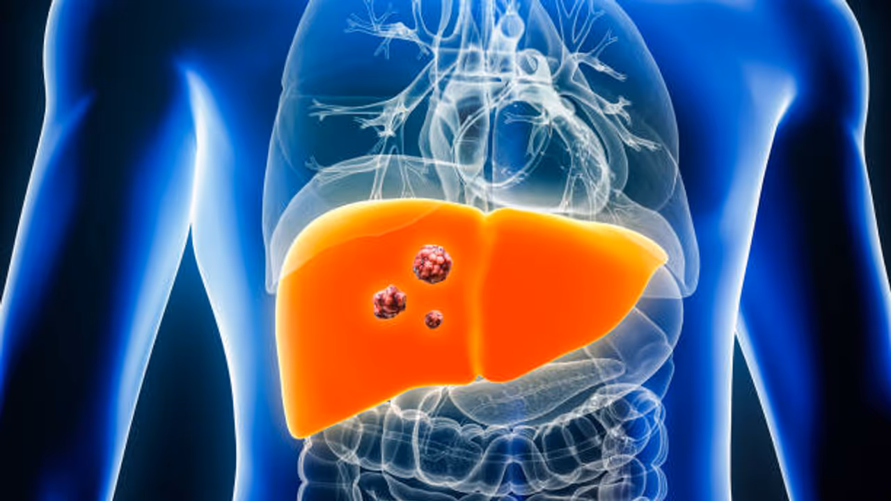 liver tumor liver tumor