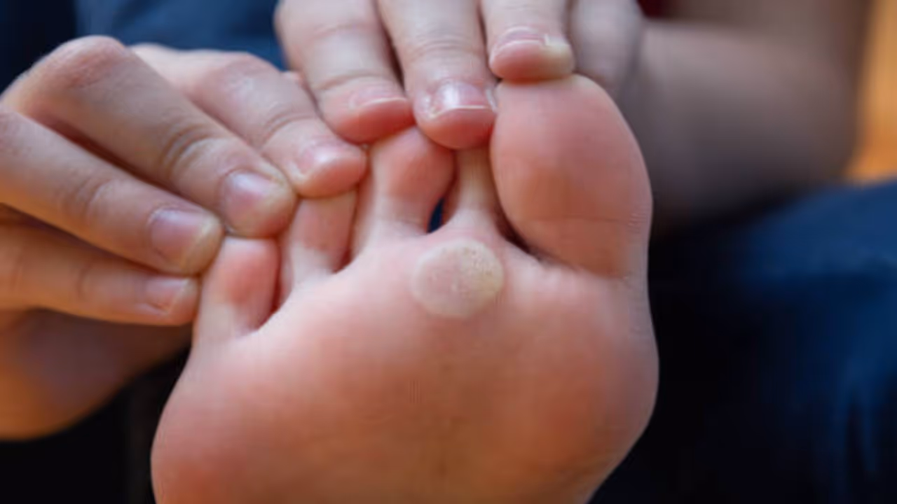 Effective Home Remedies for Calluses