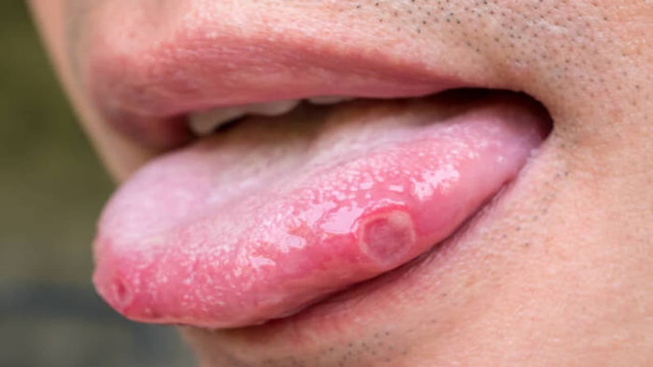 home remedies for tongue sores