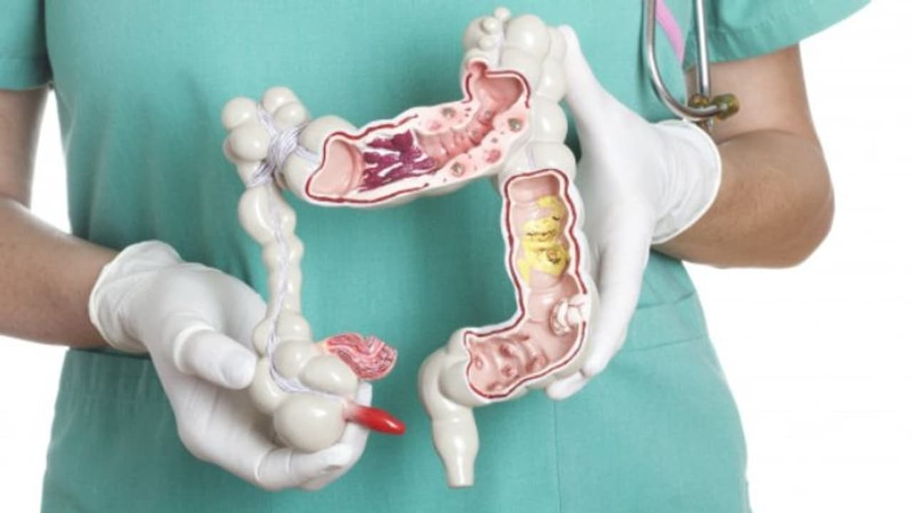 colon cancer colon cancer