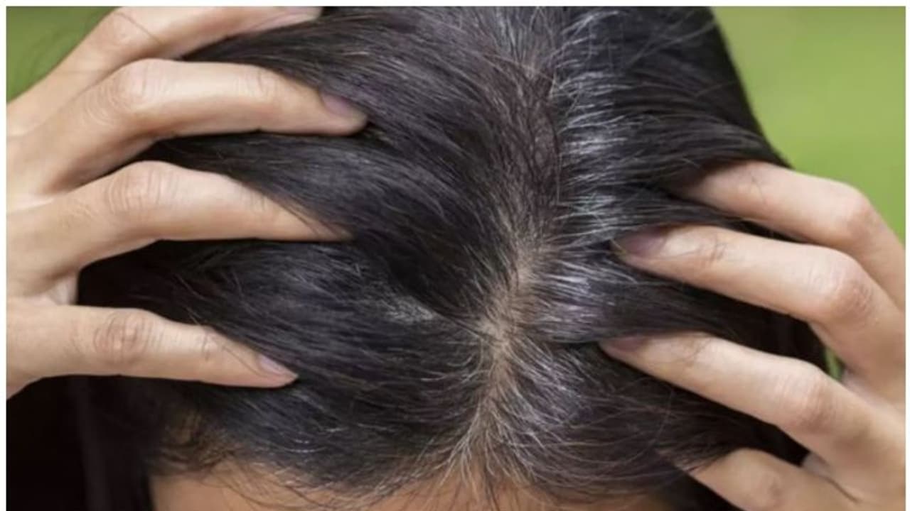 Premature grey hair Premature grey hair