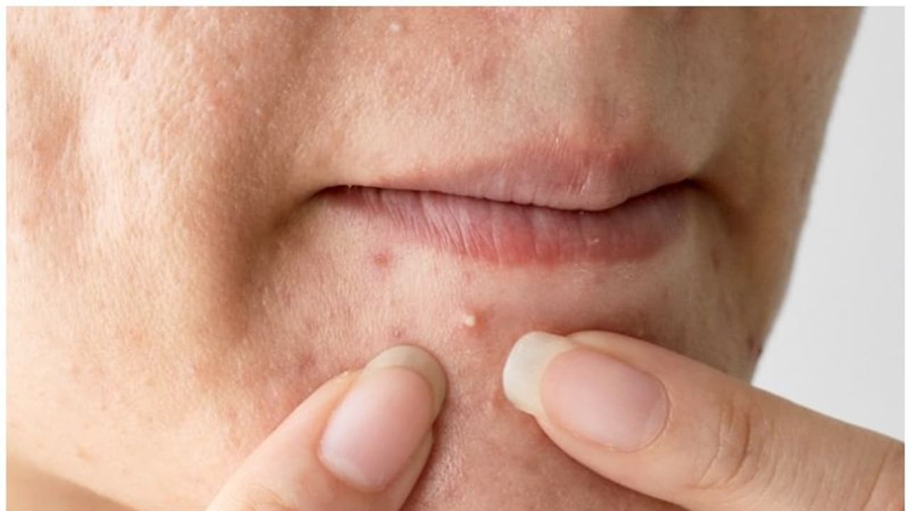 whiteheads whiteheads