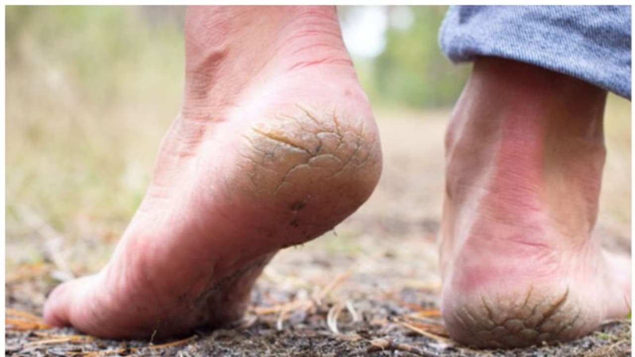 Cracked feet