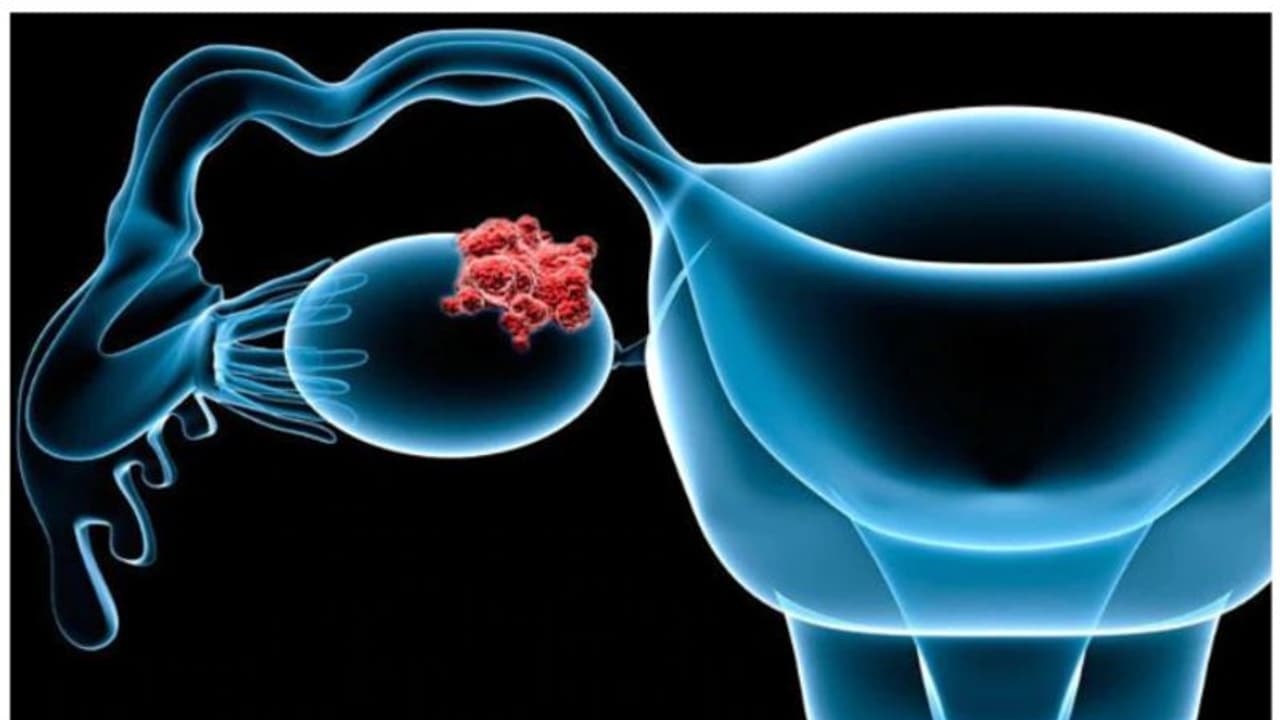 Ovarian cancer