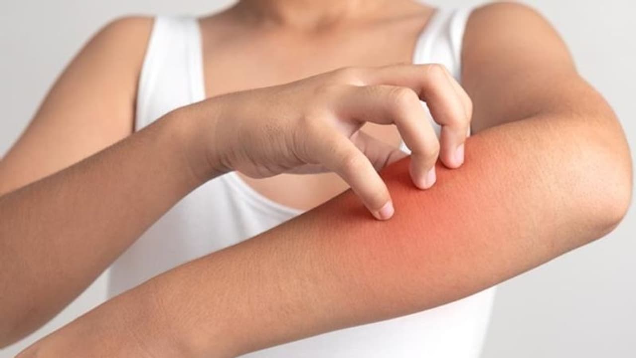 milk allergy milk allergy