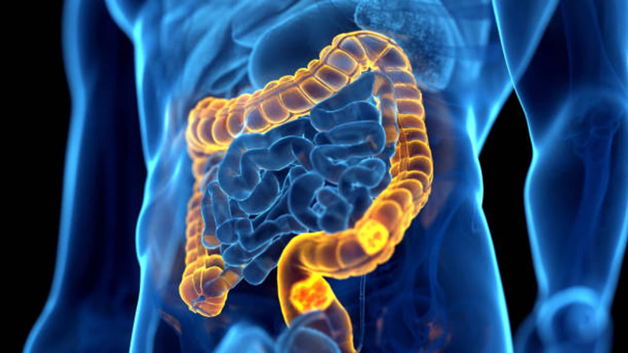 Colon cancer
