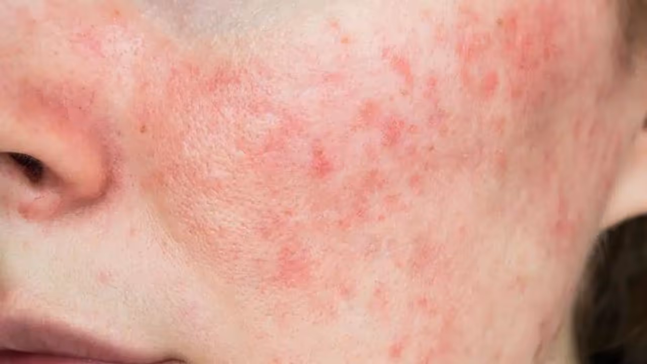 lupus lupus