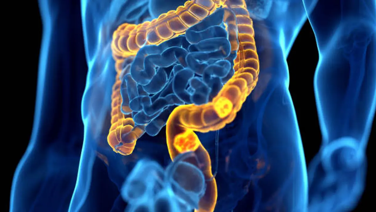 Colon cancer