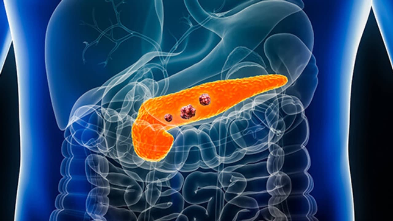 Pancreatic Cancer Pancreatic Cancer
