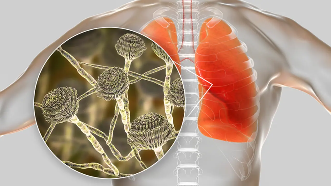 Aspergillus Fumigatus