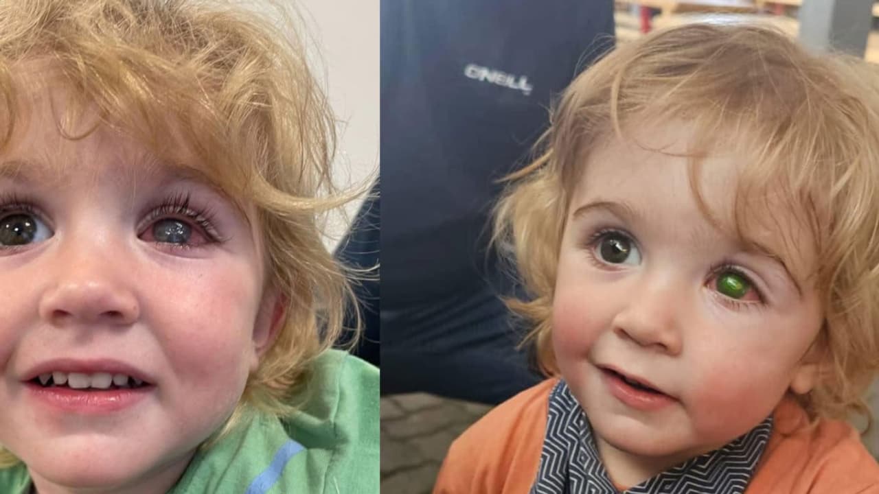 2 Year Old Loses Eyesight 2 Year Old Loses Eyesight