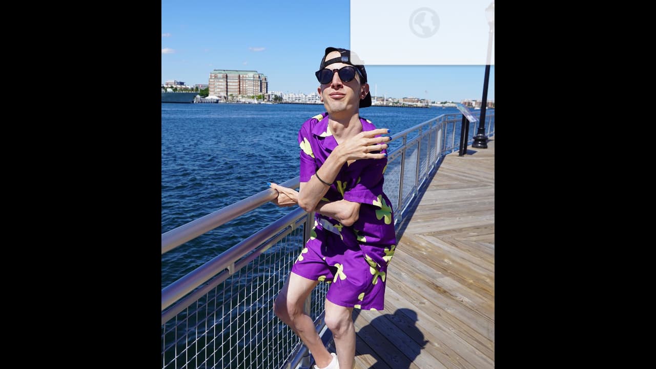 Stone Man Disease Stone Man Disease