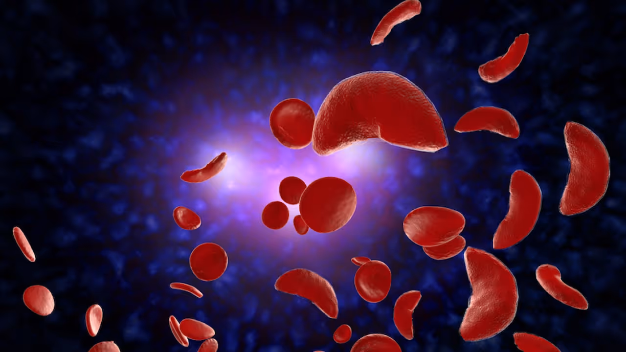 Sickle Cell Sickle Cell