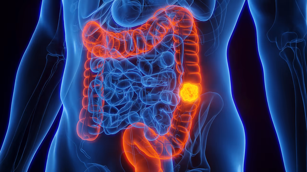 Colon Cancer Colon Cancer