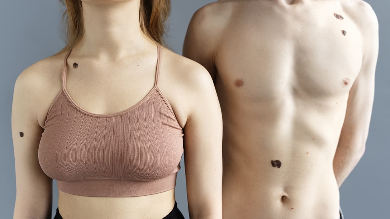 Unlucky moles on body Unlucky moles on body