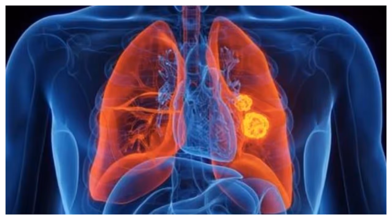 lung cancer lung cancer