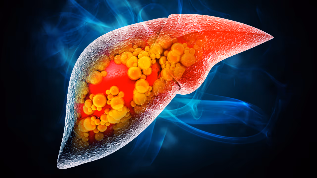 Fatty Liver Fatty Liver