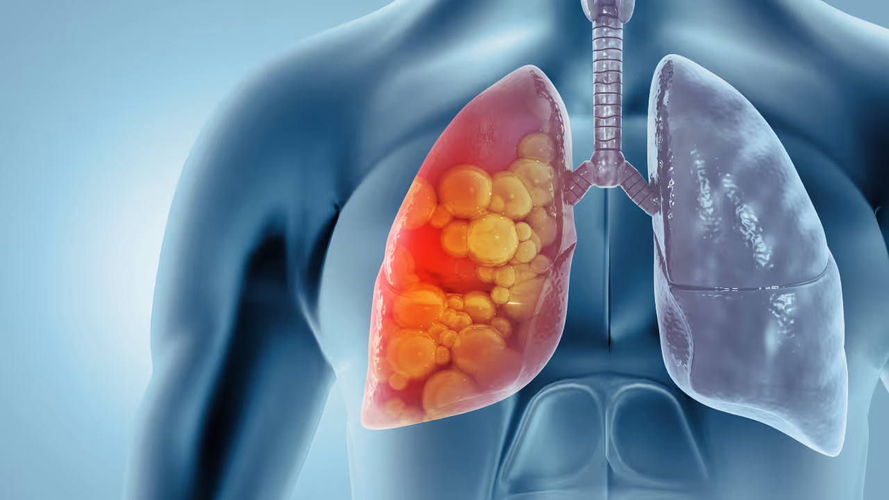 Lung cancer Lung cancer