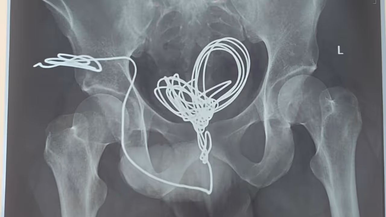 man inserted wire in urethra man inserted wire in urethra