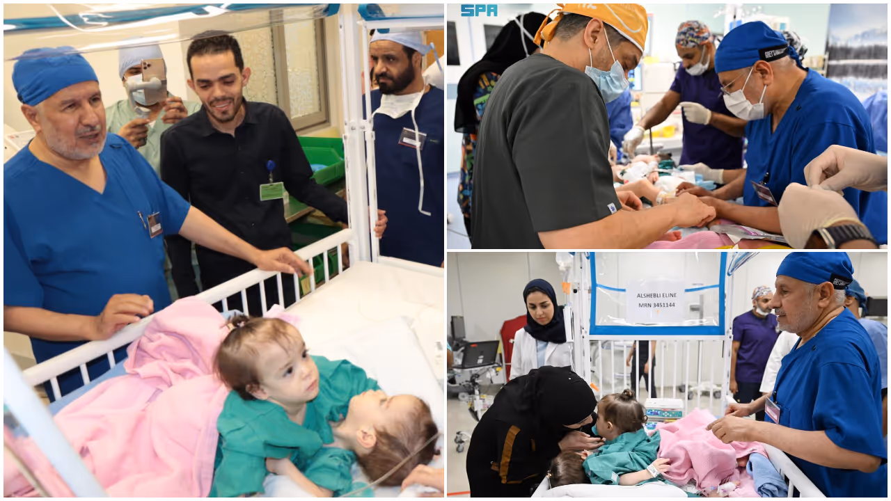 Siamese Twins Siamese Twins