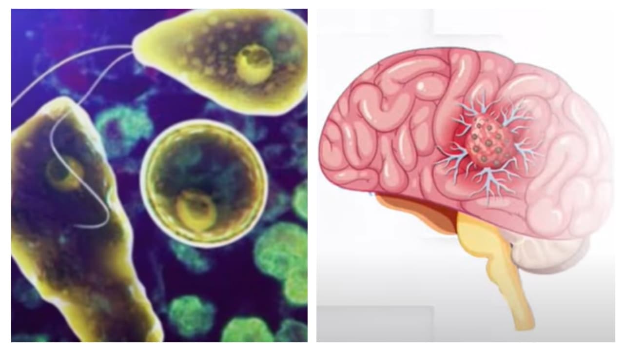 amoebic meningoencephalitis amoebic meningoencephalitis