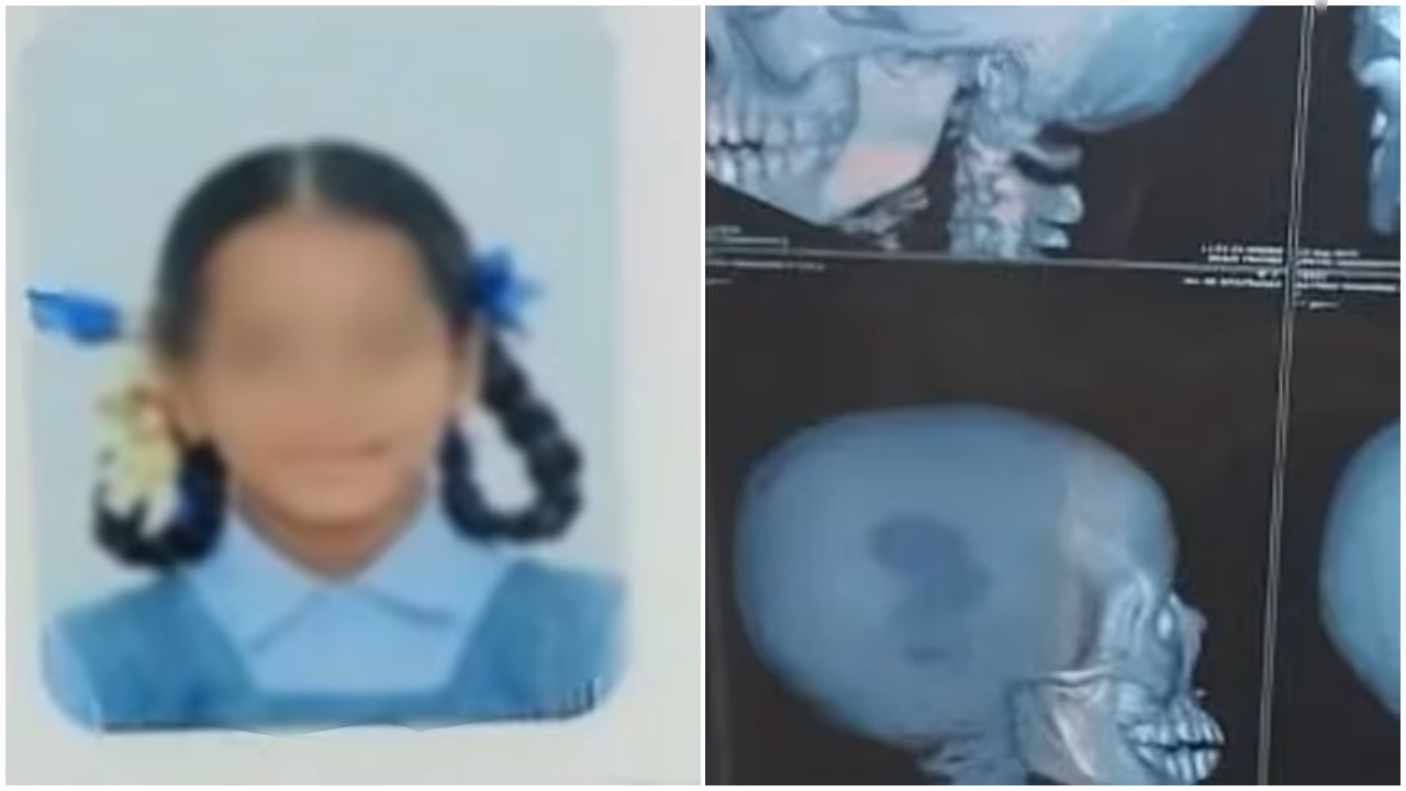 teacher beats student with bag containing lunch box student suffers skull fracture