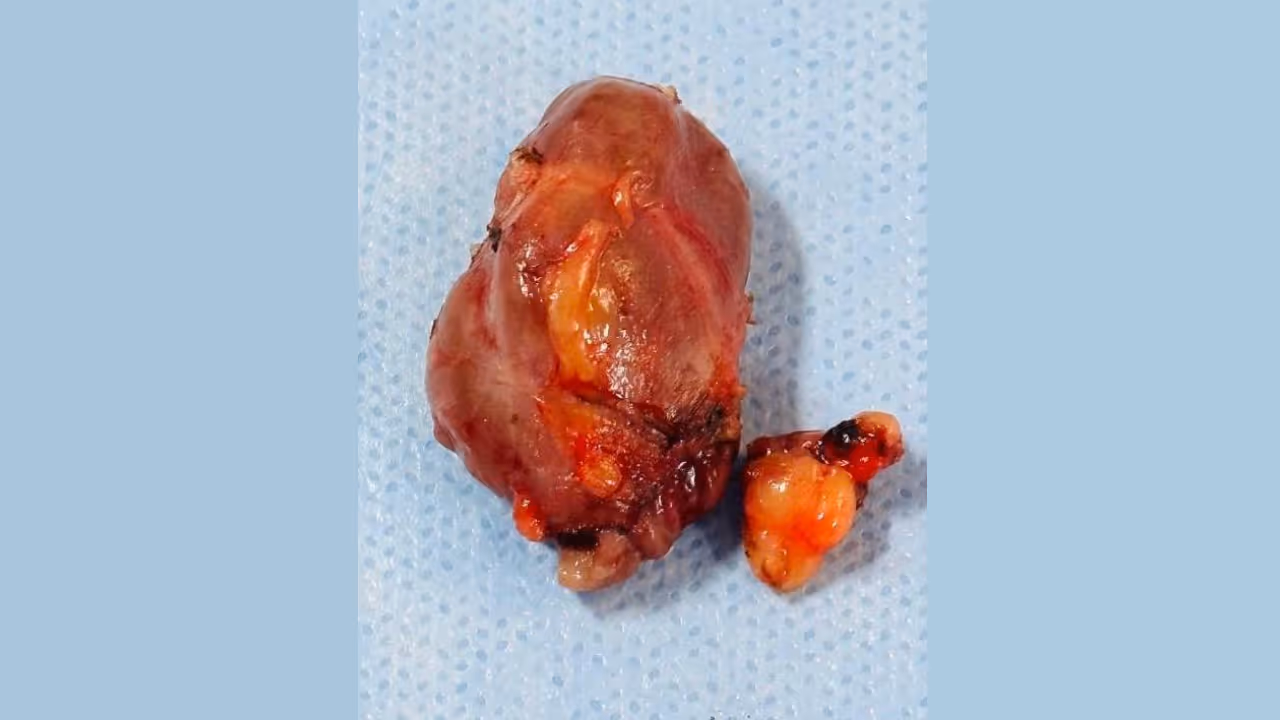  large parathyroid adenoma surgery