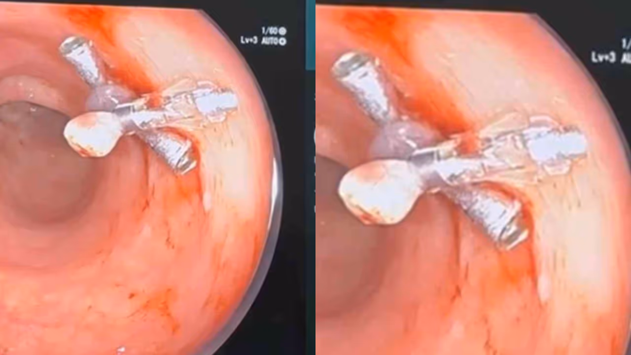 colonoscopy colonoscopy