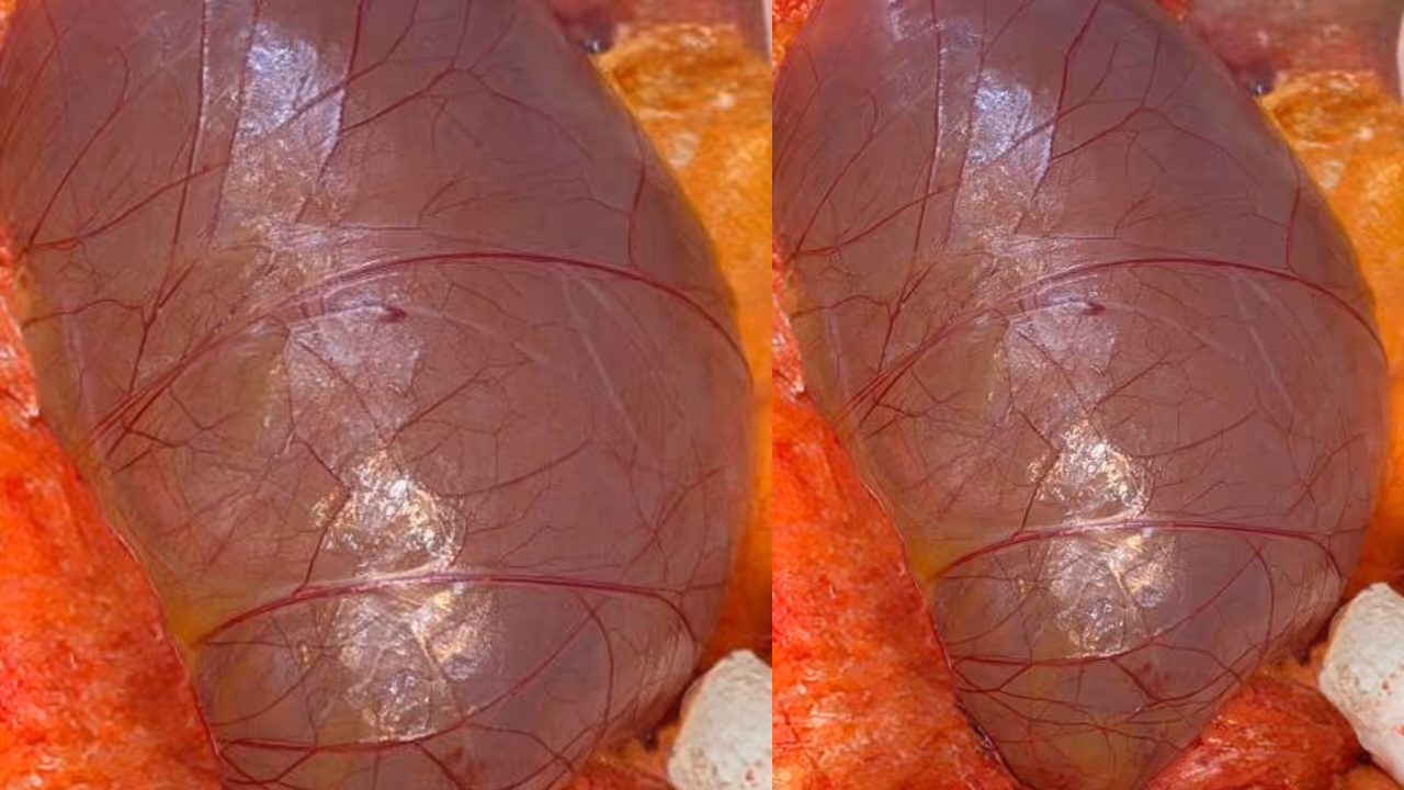 Colonic Mesentric Cyst Colonic Mesentric Cyst