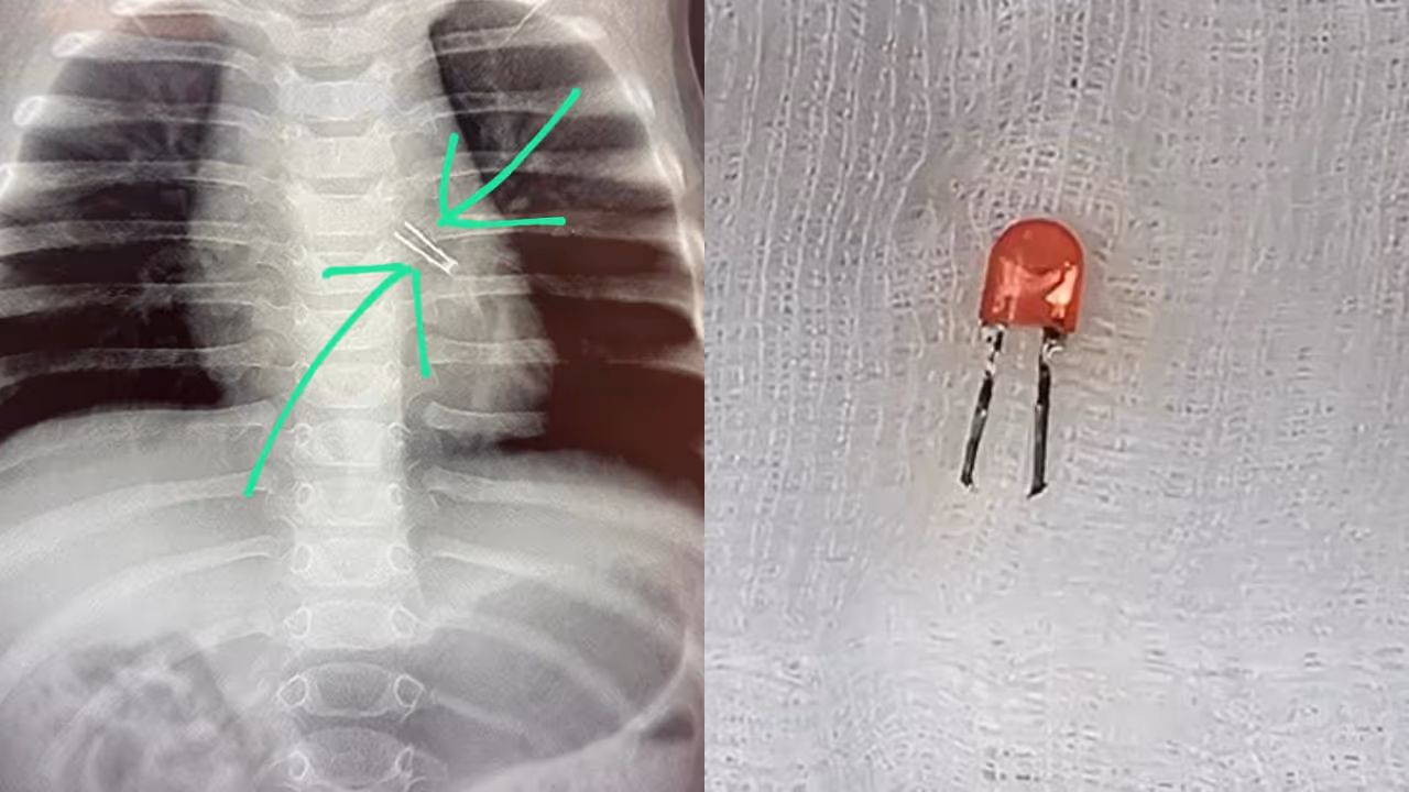 LED Bulb in Child Lungs LED Bulb in Child Lungs